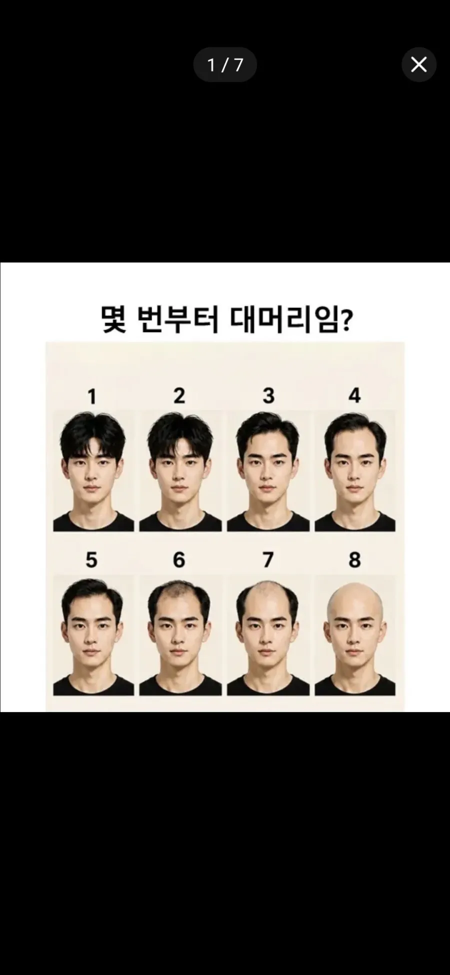 본인의 탈모진행도는 어느정도인지 알아보자